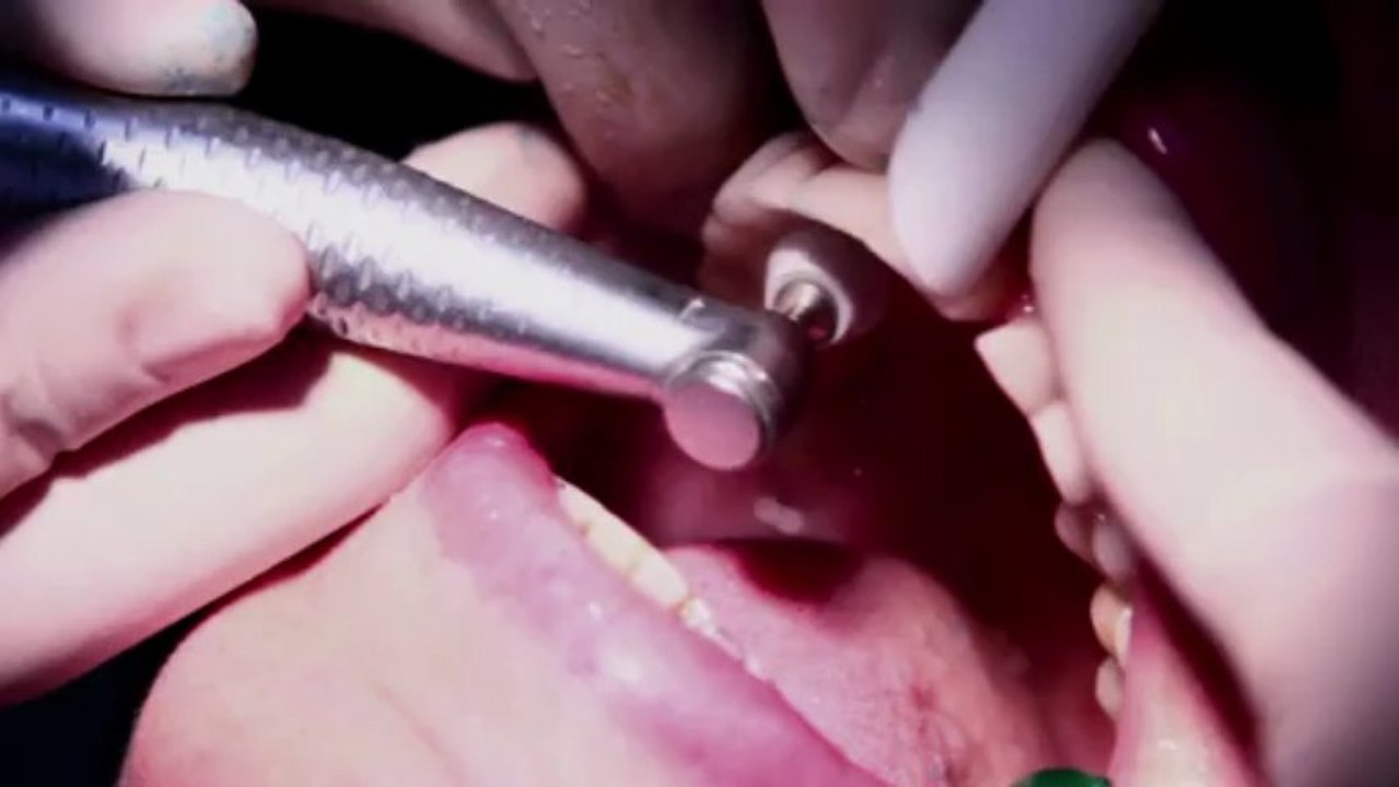 Vidéo de dentisterie esthétique: pose de facettes dentaires en 2 séances