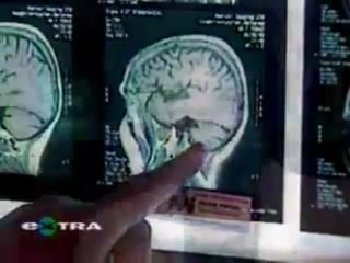 Simple signs and symptoms of migraine that devastate your mental peace