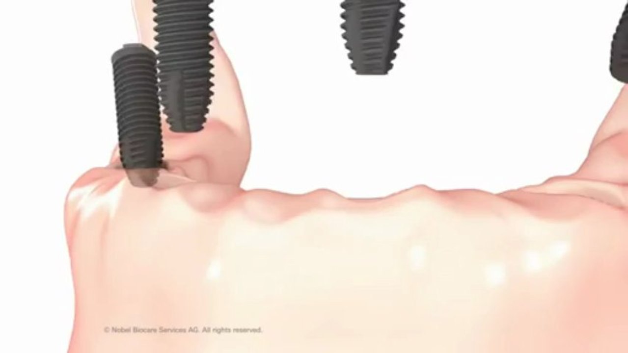 Single Dental Implants