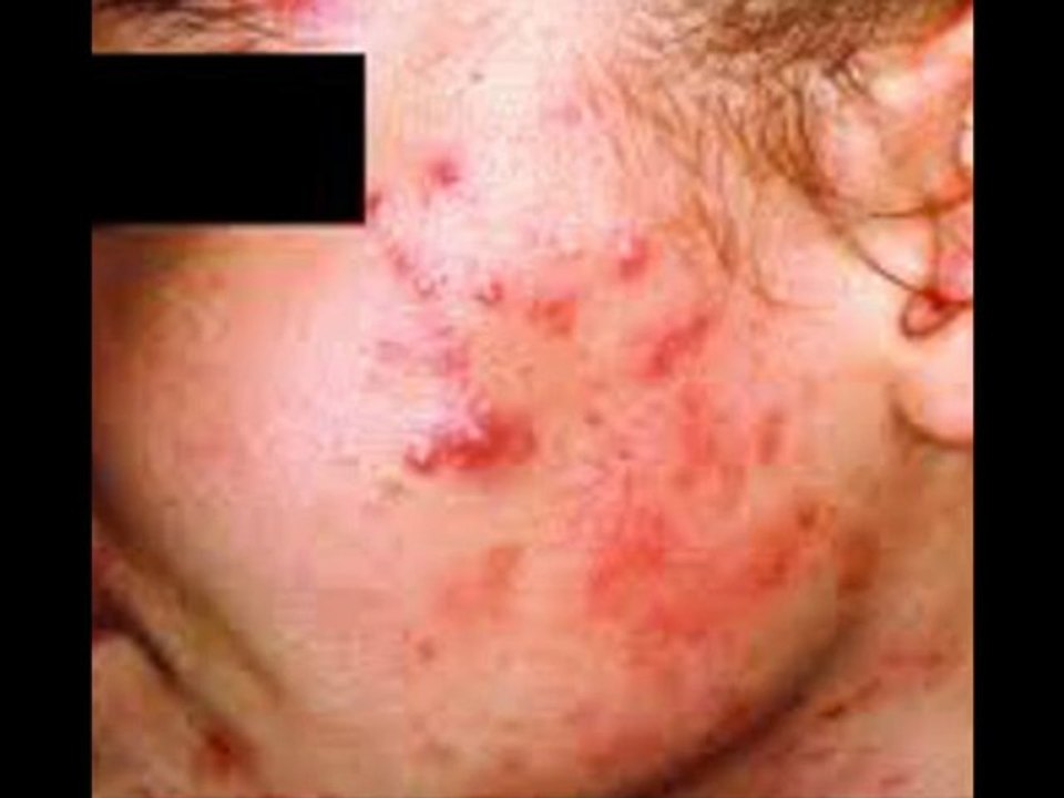 Pimples Rant