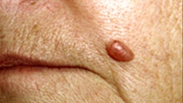 How To Know When You Should Get A Mole Checked
