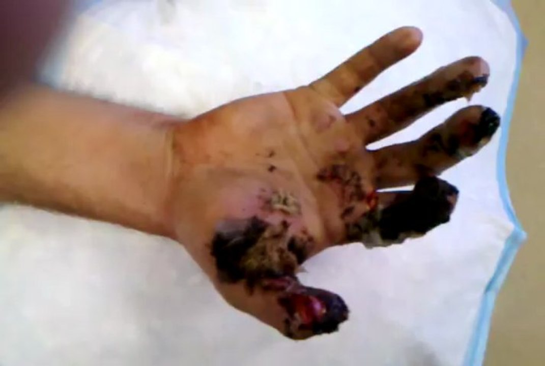 post op vid