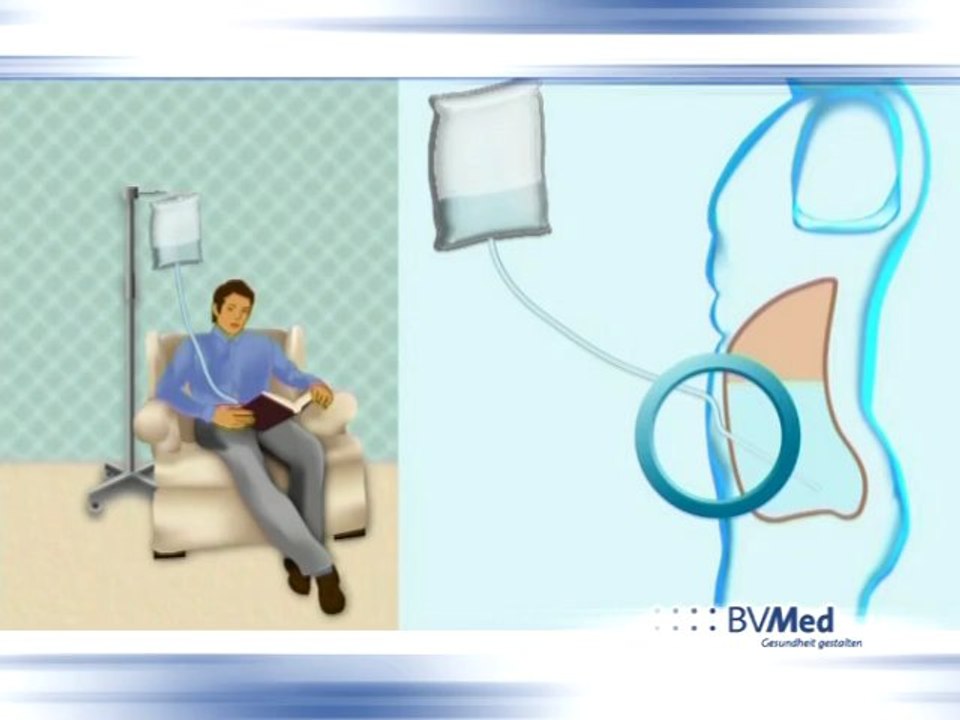 Bauchfell-Dialyse: Unabhängig leben trotz Nierenversagen