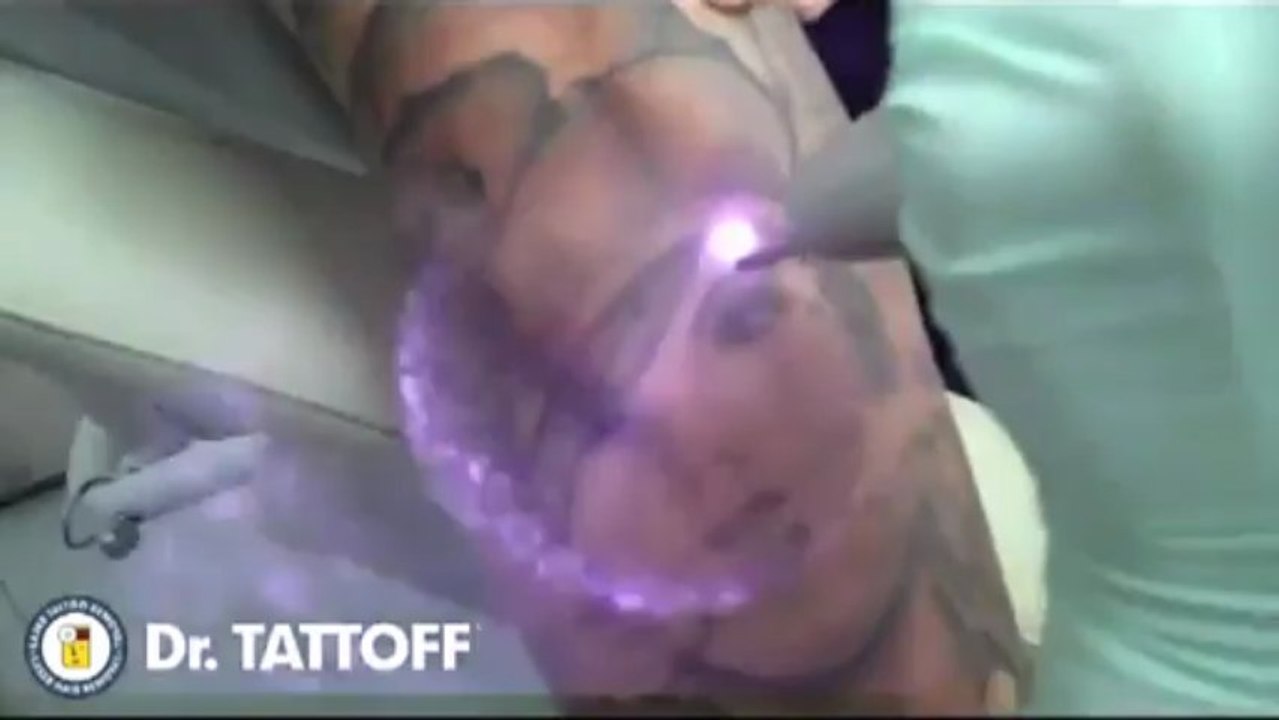 Effacer un tatouage au laser