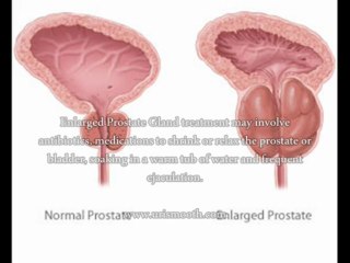 How to alleviate prostate problems?