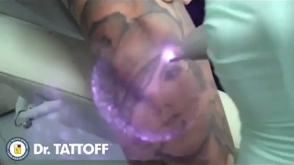 Enlever un tatouage au laser !