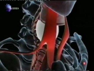 Asfixia: Muerte por bola de billar