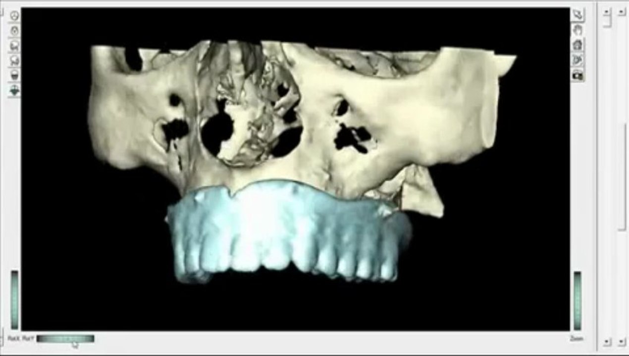 Single Dental Implants
