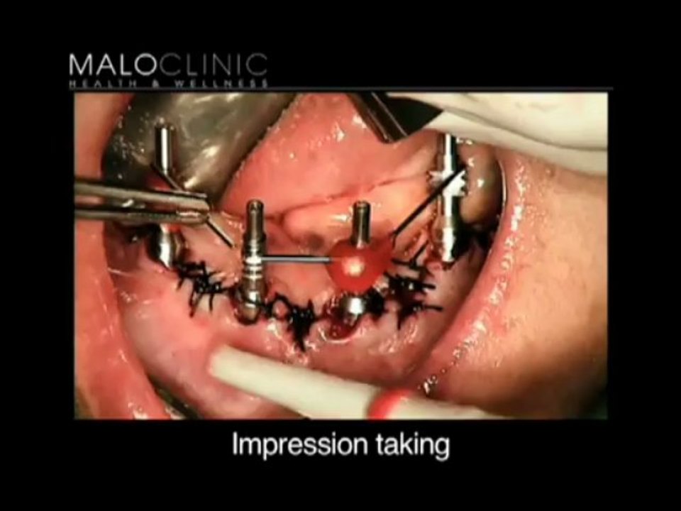 Get New Teeth in One Day With All-on-4 Dental Implants