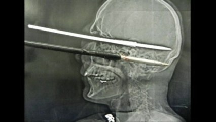 Brazilian man harpoons himself in the head, survives