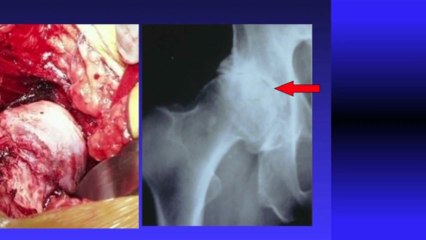 Understanding Arthritis: Causes, Risks, and Differences from Osteoporosis 🩺