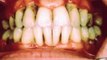 Bleeding Gums Could Be A Dental Warning Sign - OraMD
