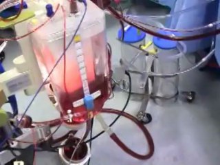 Join Harefield Hospital as a Perfusionist – Make a Difference in Cardiac Care 🩺