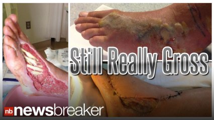 GRAPHIC: NEW: Producer Who Almost Lost Foot to Snake Bite Tweets New, Gross Photo of Foot