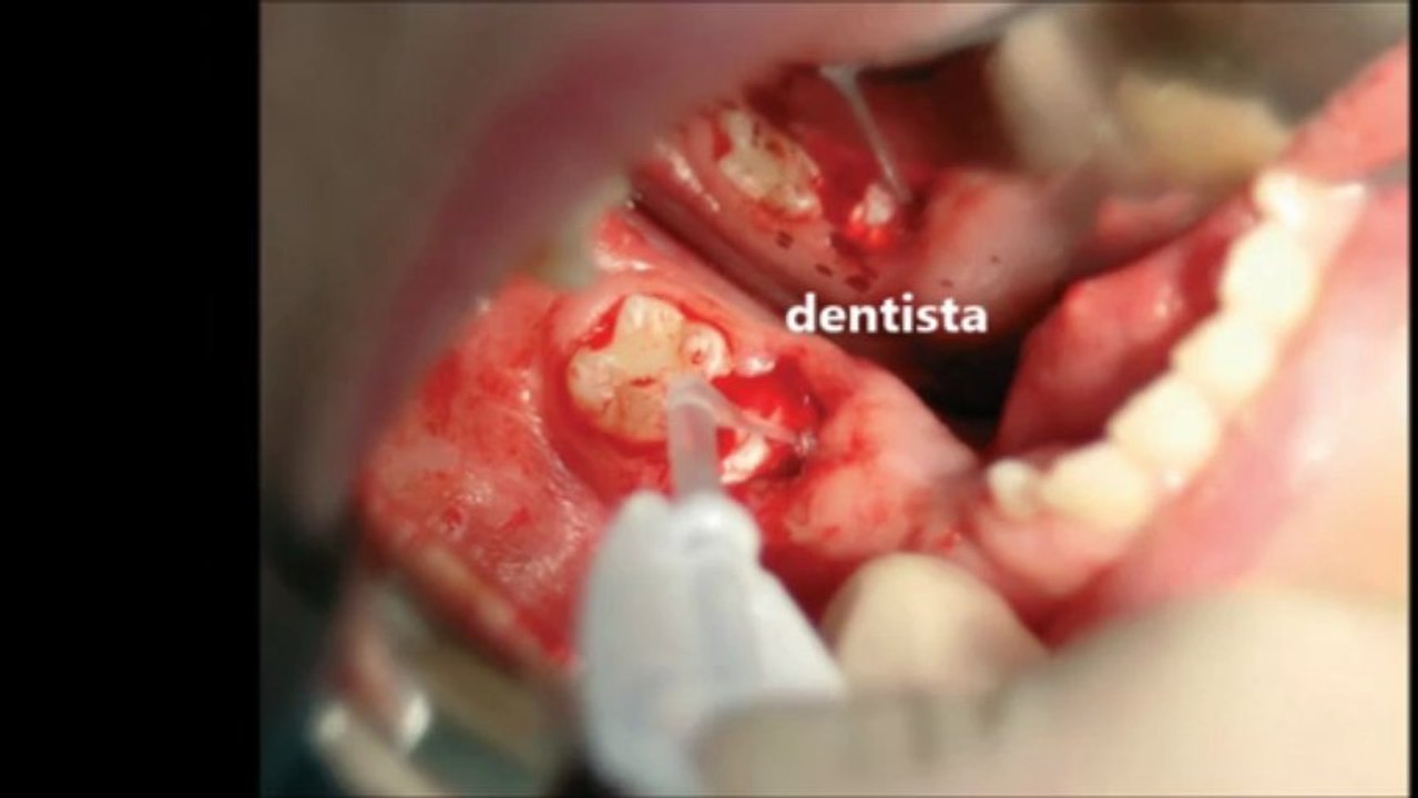 Colla per dentista e odontoiatria