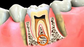 Severly decayed tooth? Stop worrying! We are here to save your tooth.