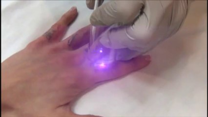 Does Tattoo Removal Hurt? Undoo Tattoo FAQs