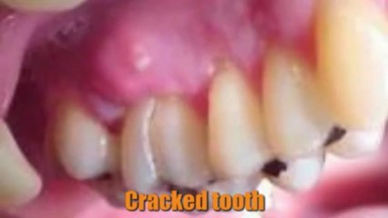 Los Gatos Dental Implants