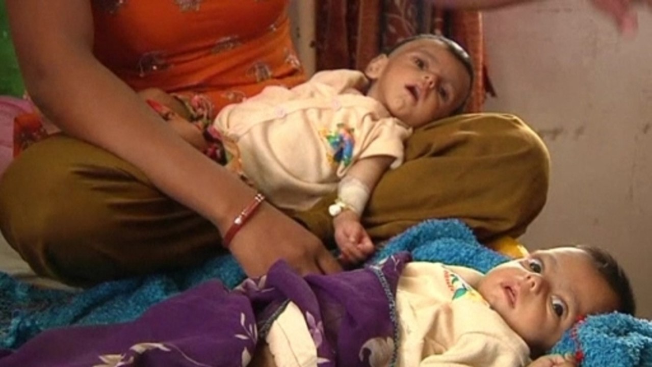 India's 'butterfly lifespan' babies