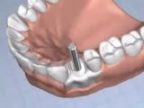 Dr Rodney Aziz - Dental Implant Animation Video