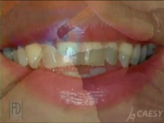 Dr Abid Faqir - Progressive Dental - Veneer Procedure Video