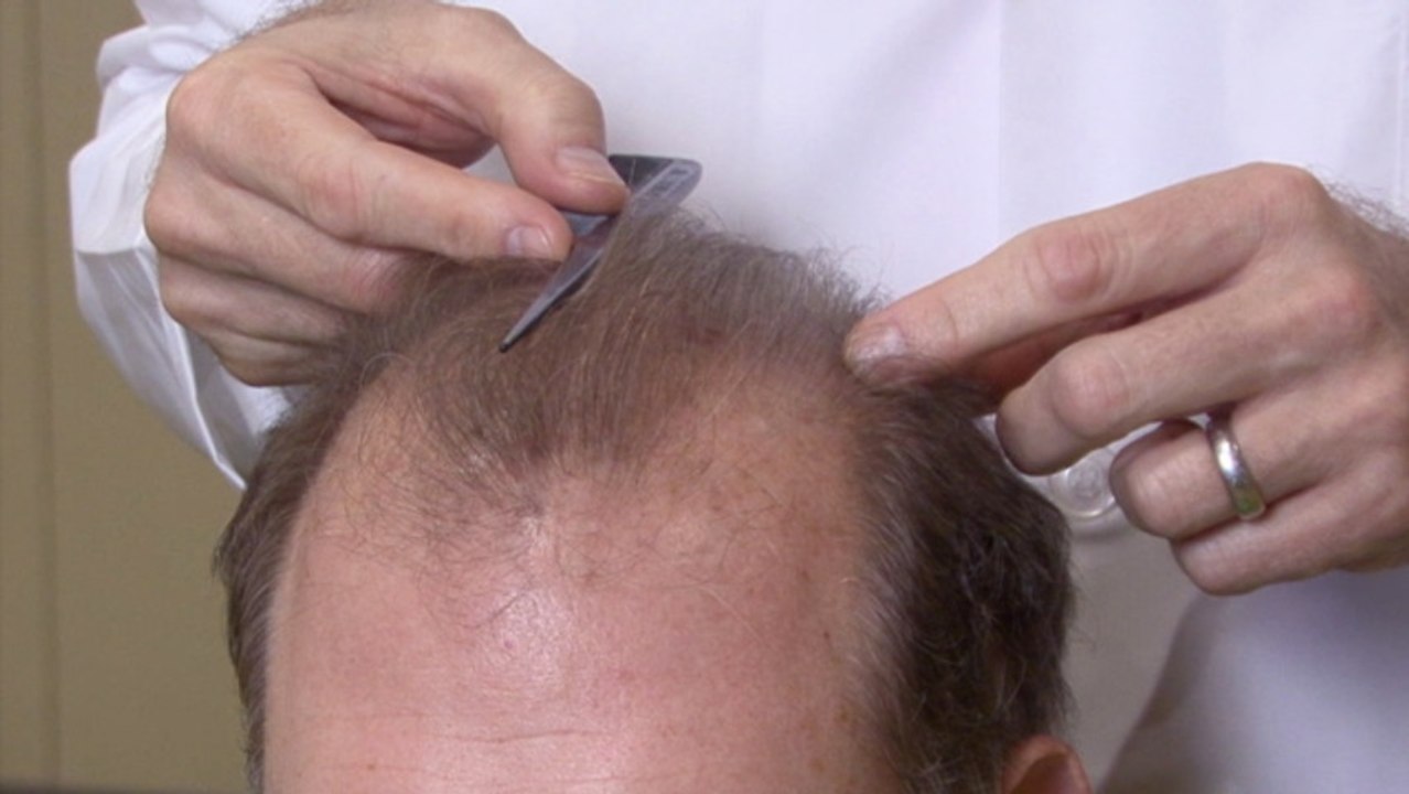 Hair Loss Treatments For Men