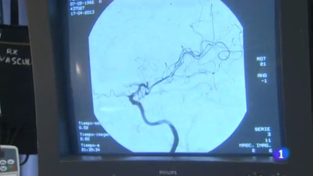Ictus (ACV): El tiempo es vida (Angioplastia)