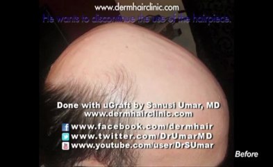Body hair transplant for severe baldness with uGraft - Dr Umar