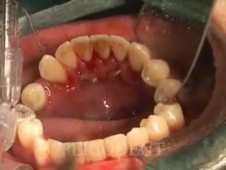 Dr Abid Faqir - Supragingival Scaling Video