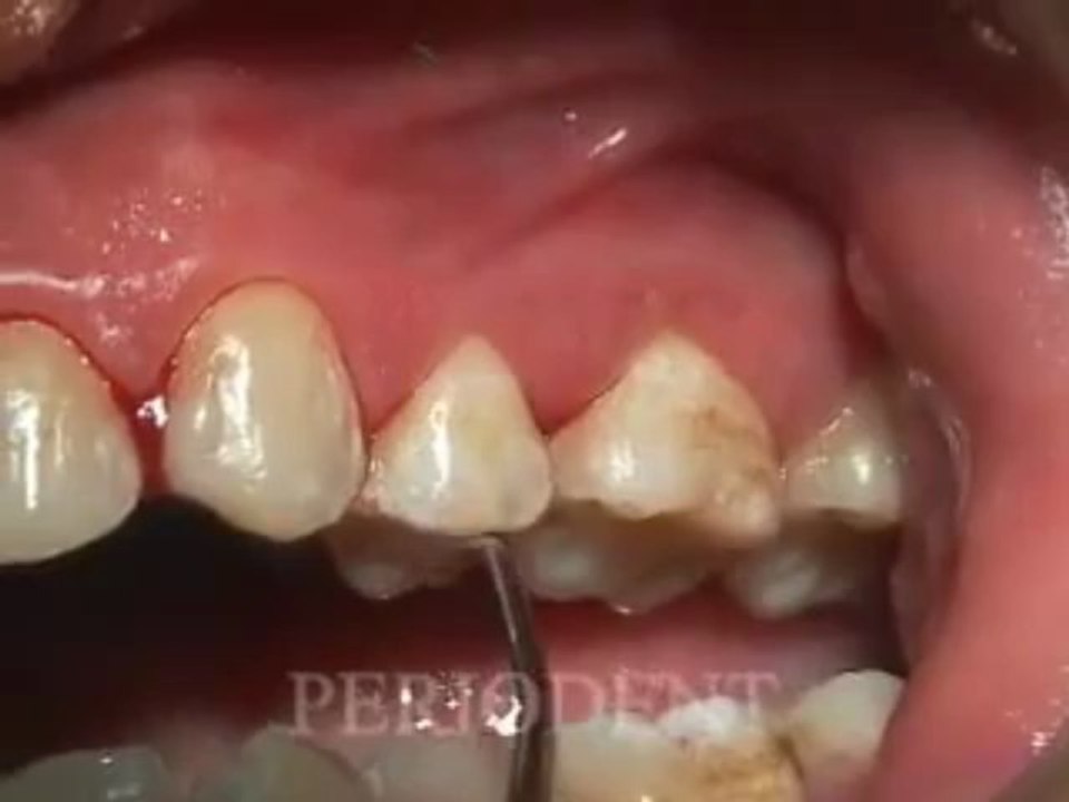 Dr Rodney Aziz - Subgingival Scaling and Root Planing