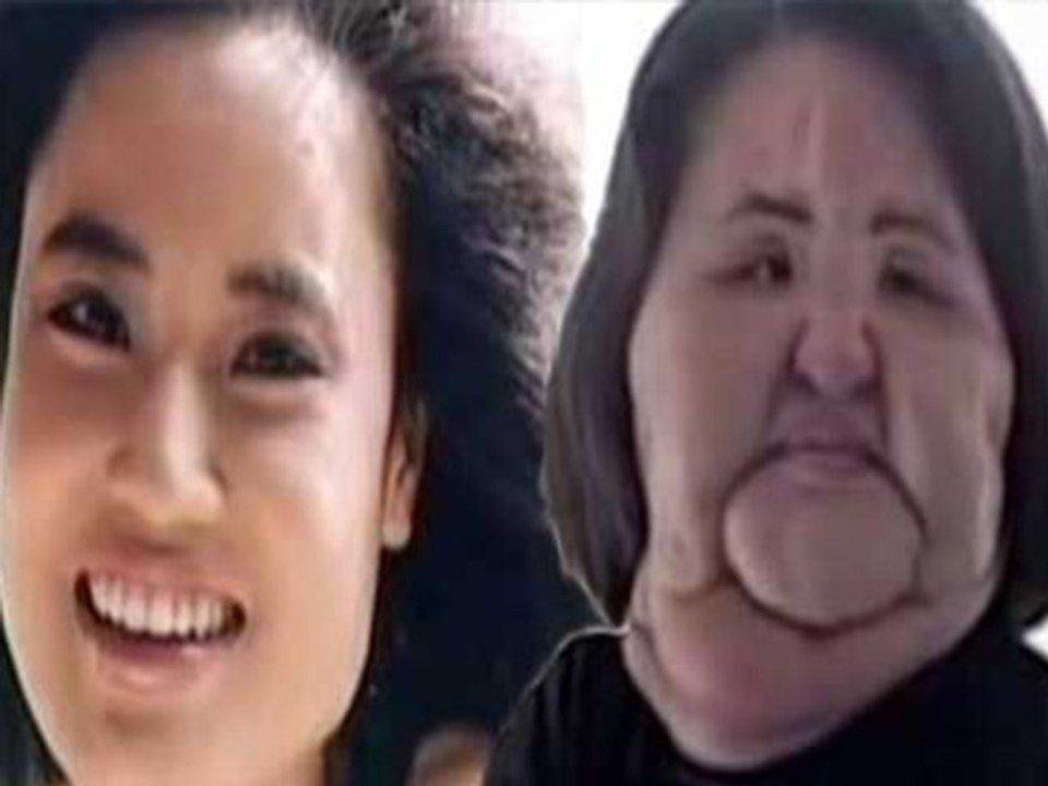 Hang Mioku Injected Cooking Oil Into Her Own Face video Dailymotion