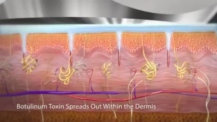 Treating Hyperhidrosis of the Palm