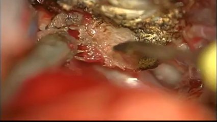 anterior clinoidal meningioma by Prof Dr Selçuk YILMAZLAR