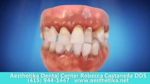 tmj dentist  san francisco ca | prosthodontics | sleep apnea