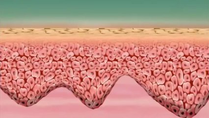 Skin Resurfacing, Pixel RF from Alma Lasers