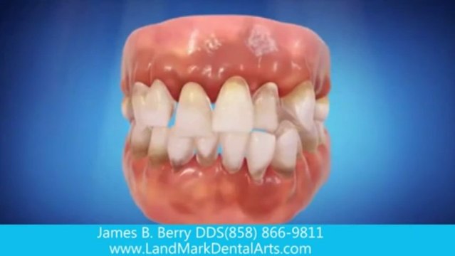 invisalign San Diego ca | clear braces | invisible braces