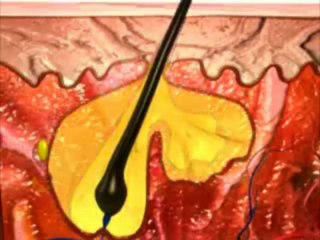 What is acne Acne formation process