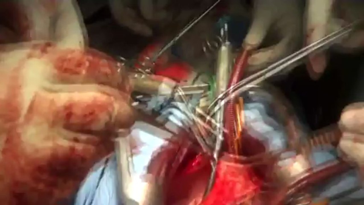 Operation of a case of Stab injury ti heart 02