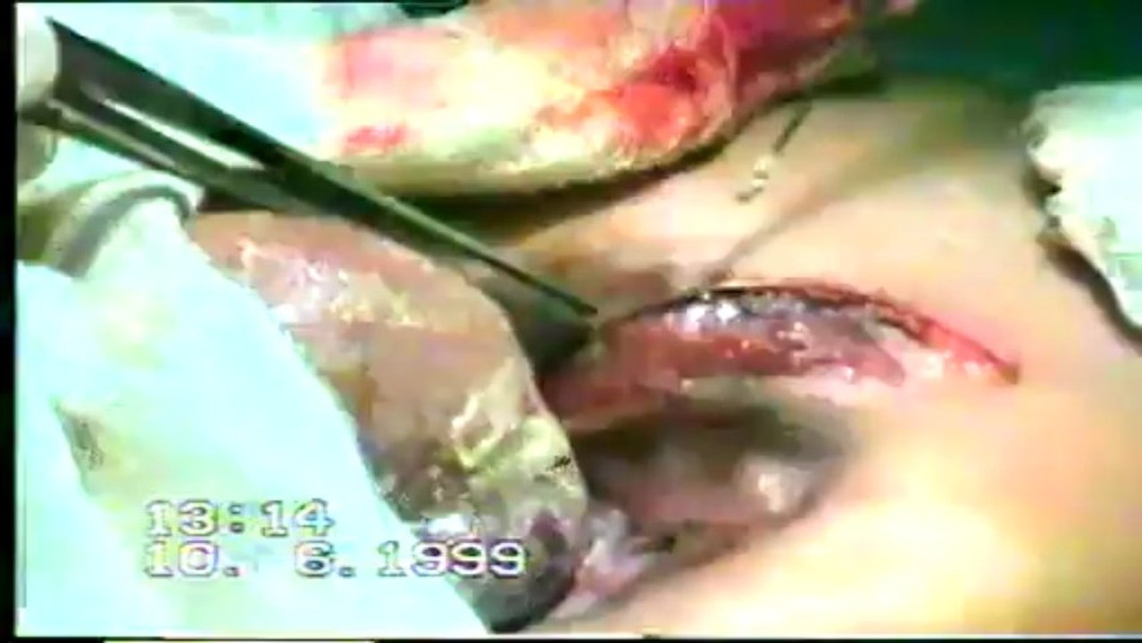 Operation of a case of Ectopia-Cordis [Video_2]