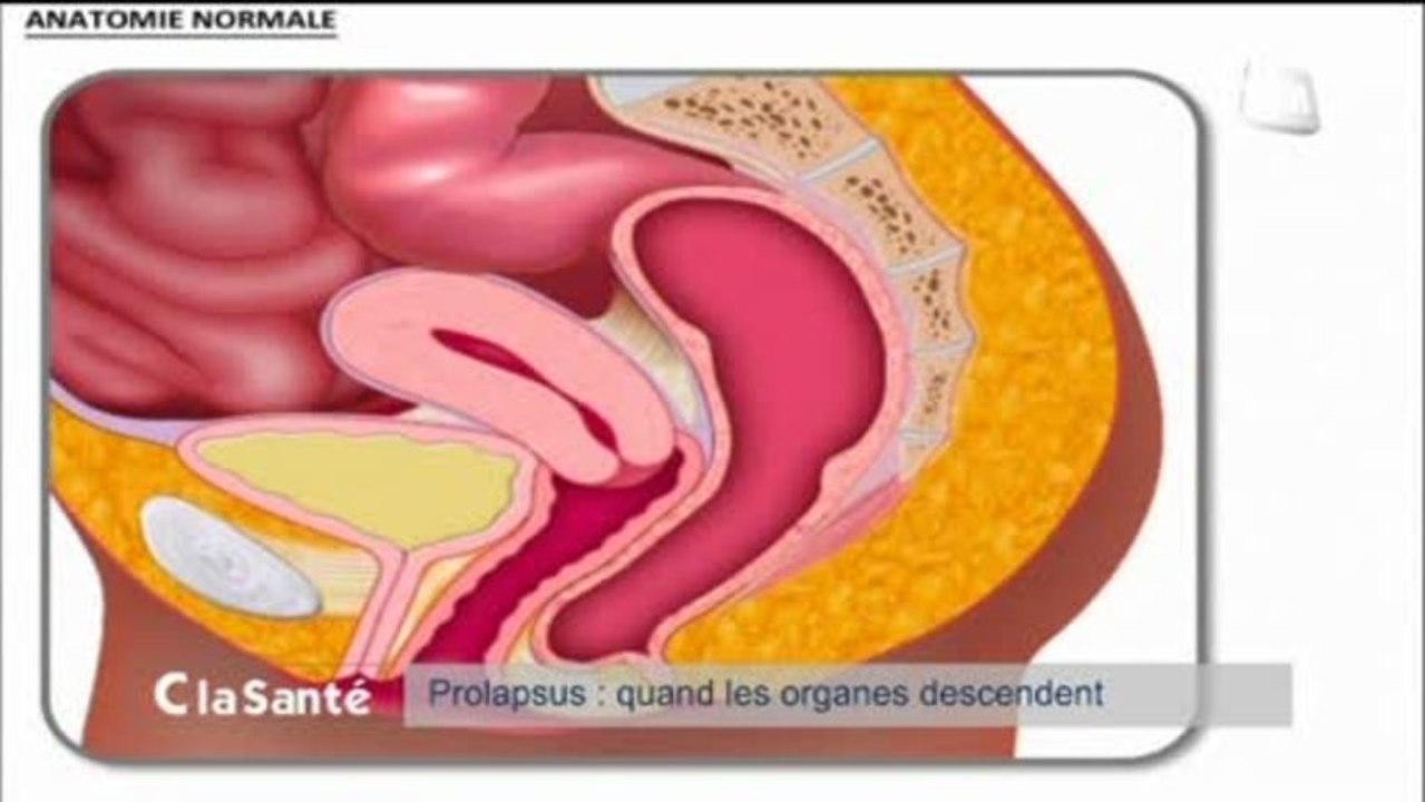 C La Santé : Prolapsus, quelles solutions ?