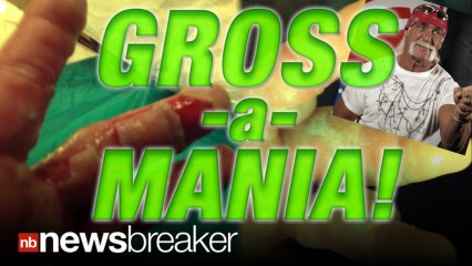 GROSS: Wrestler Hulk Hogan Tweets Pics of Badly Burned Hand