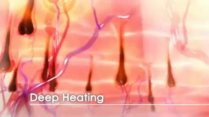 Spa SHR by Alma Lasers, Virtually Pain-Free Hair Removal wit