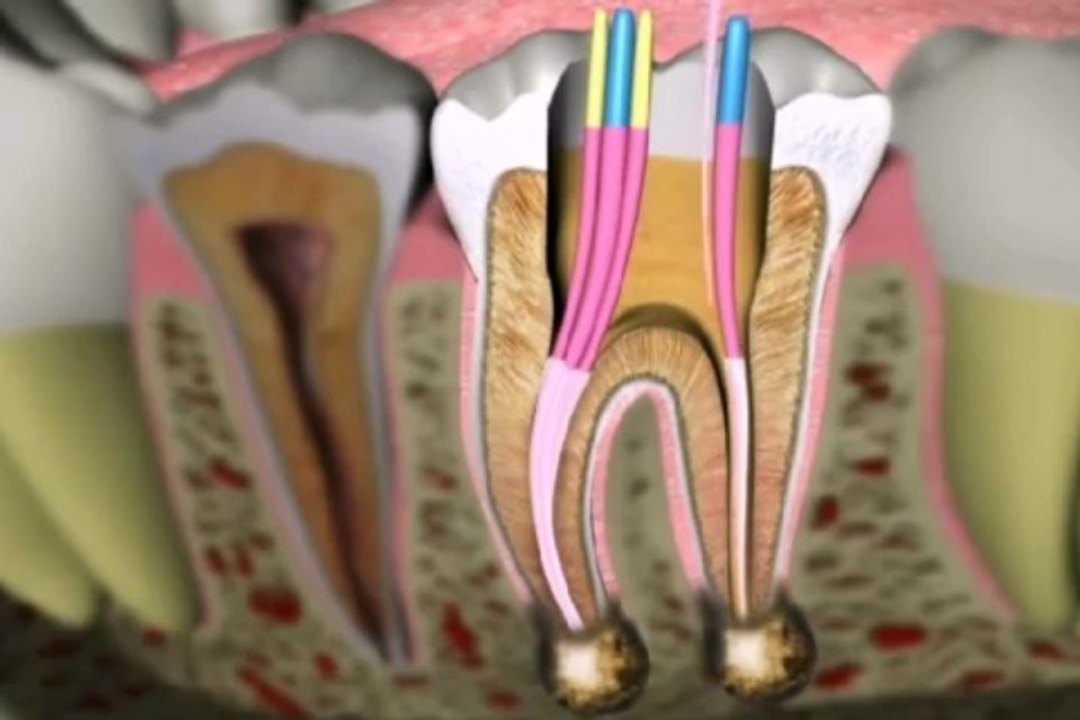 Endodontics Root Canal Therapy Beverly Hills video Dailymotion