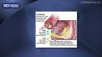 MD-VOD - Cholesterol with Dr. Ralph Brindis