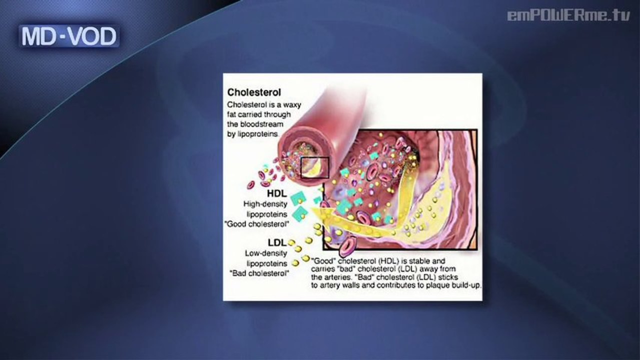 MD-VOD - Cholesterol with Dr. Ralph Brindis