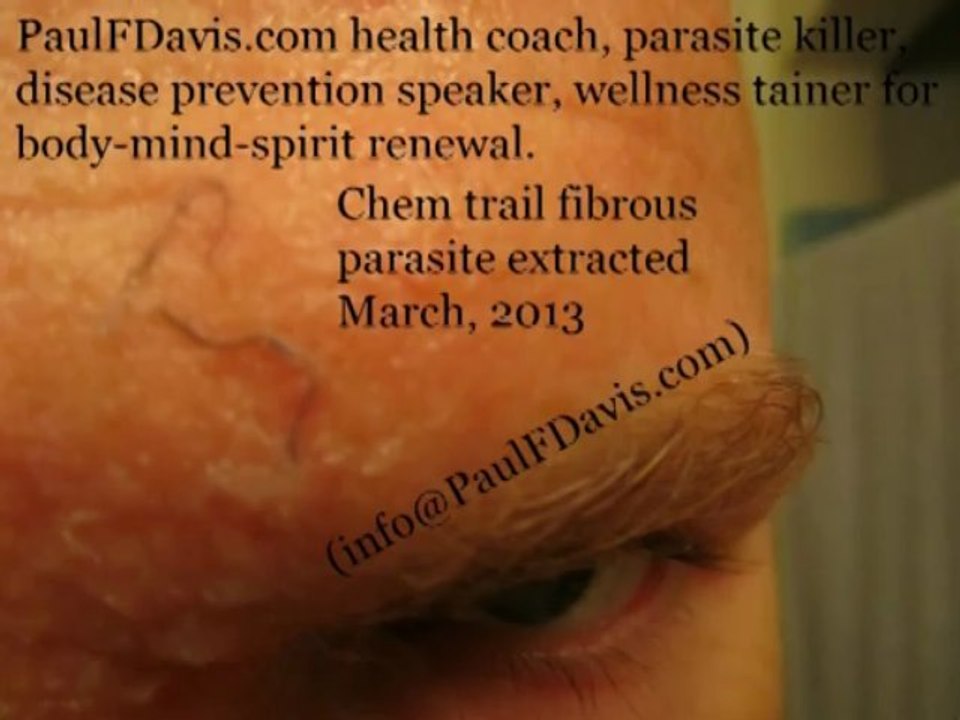 Forensic Autopsies of Dead Bodies - Morgellon Brain Parasites