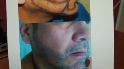 FUE treatment for hair rejuvenation!
