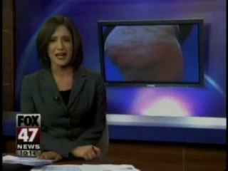 Cellulite - What Can You Do_