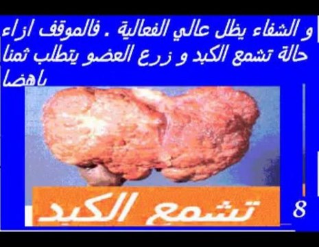 Hépatite virale C- Informations générales.-Dr AMINE A.-Casablanca-Maroc