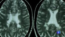 Esclerosis multiple: La enfermedad de las mil caras
